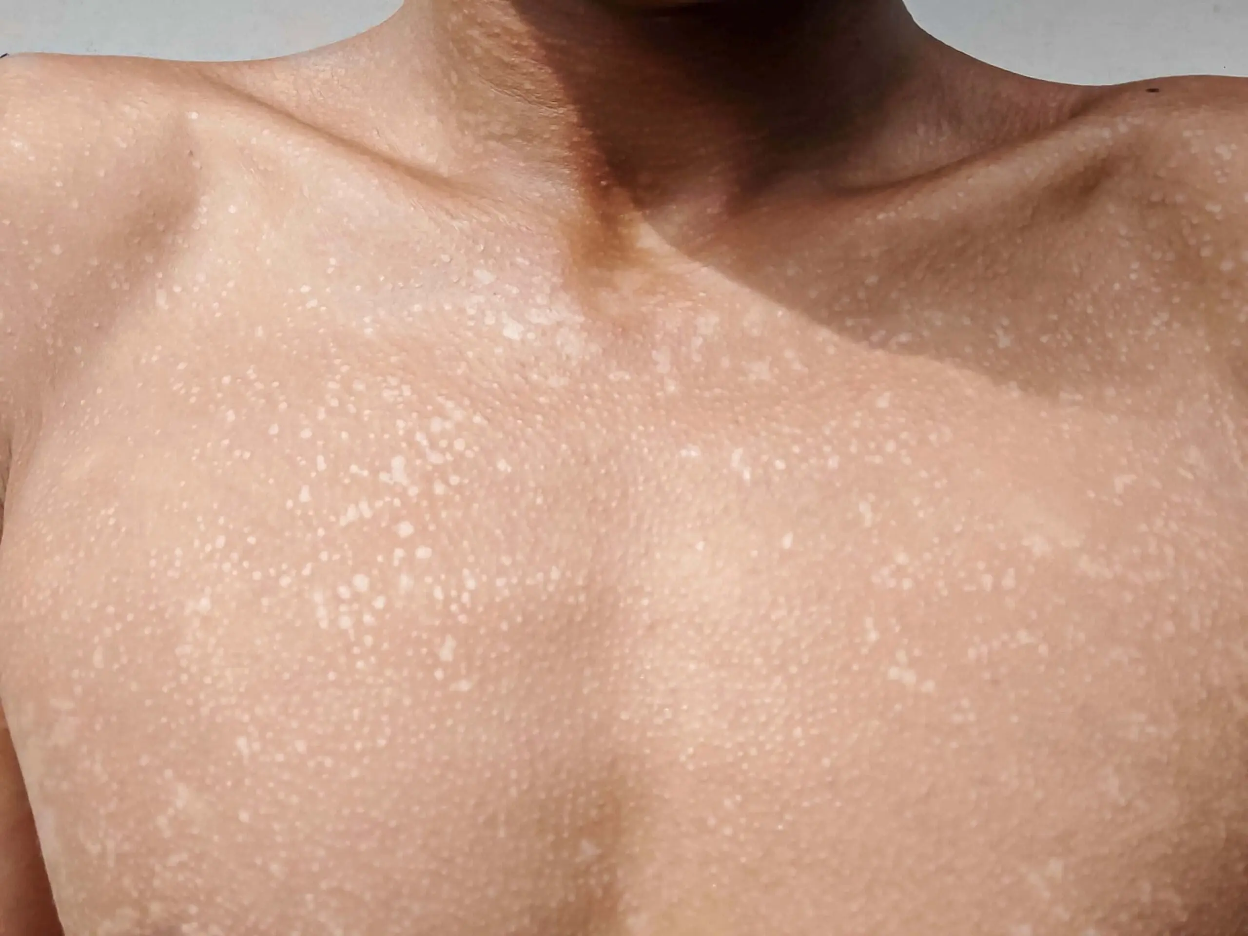 Tinea Versicolor white spots on the chest