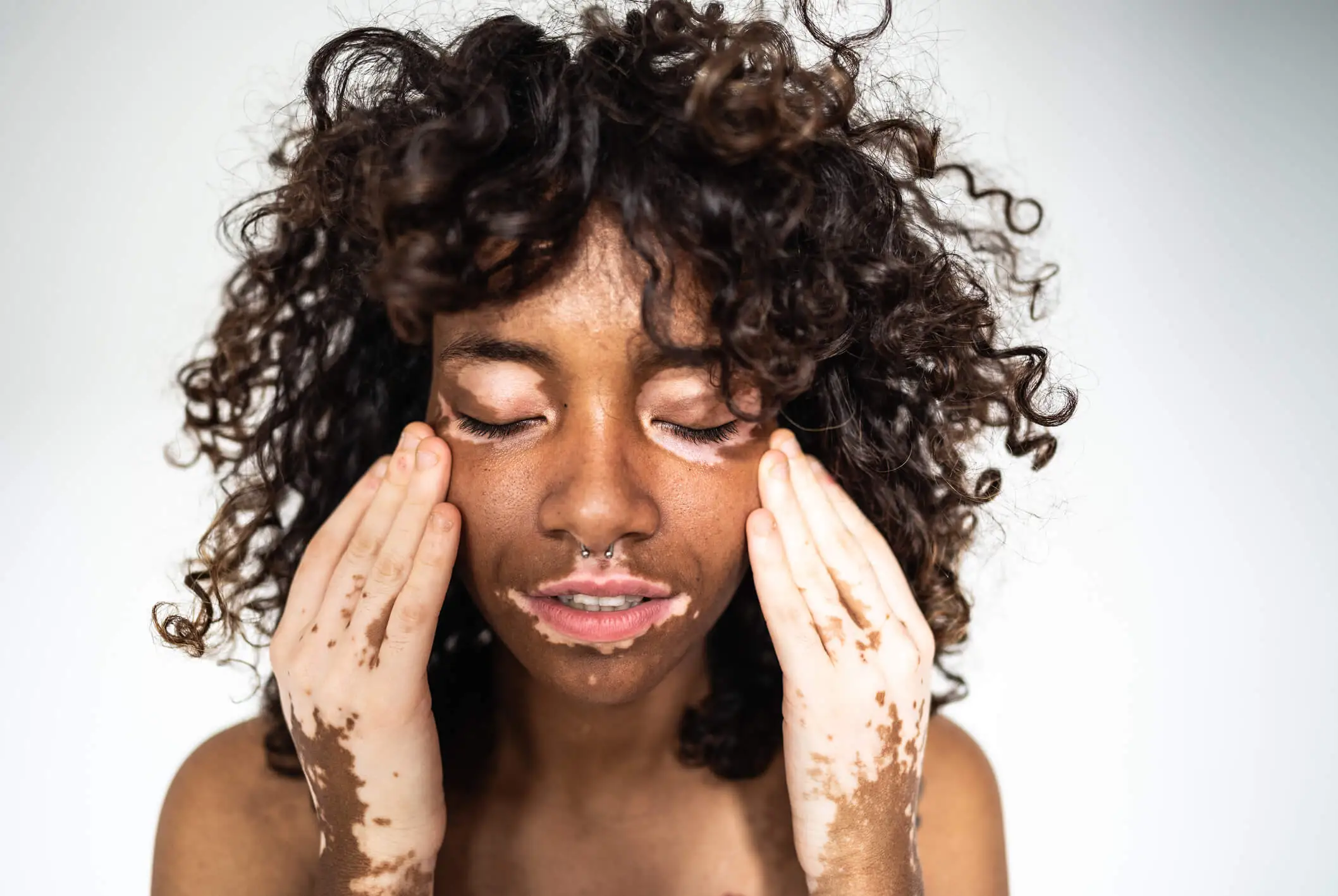 face and hands with vitiligo